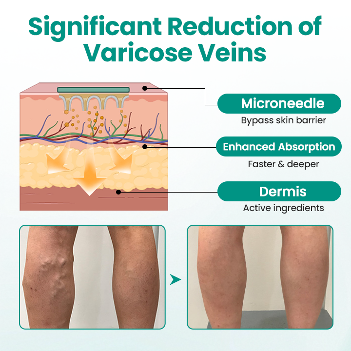 TimilkĀ® LegRenew Varicose Veins Patch