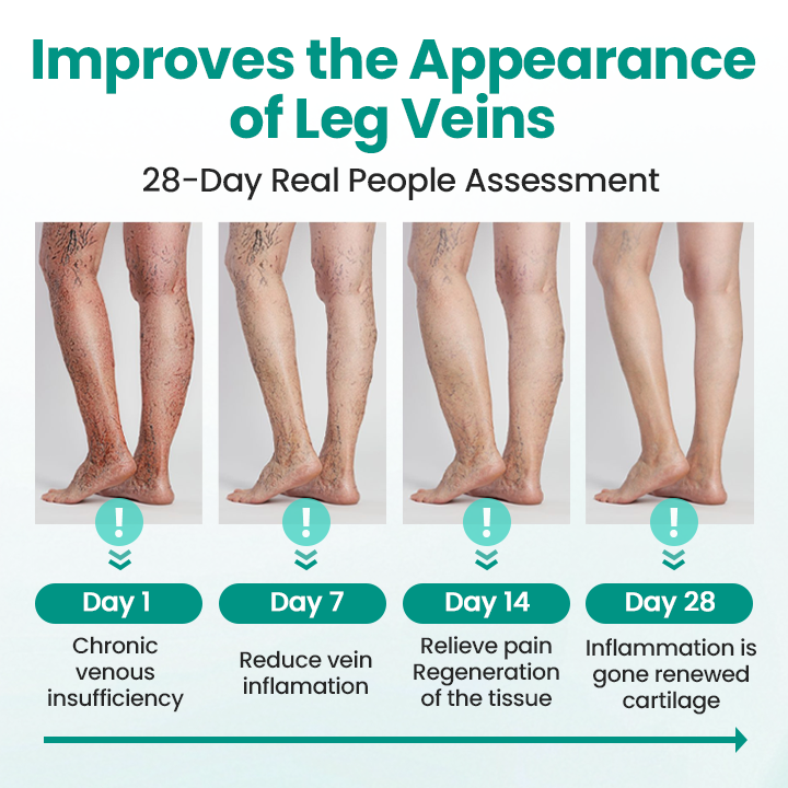 TimilkĀ® LegRenew Varicose Veins Patch