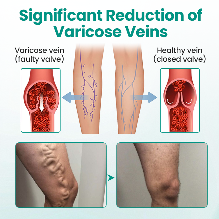 TimilkĀ® LegRenew Varicose Veins Patch